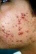 Acne nunca mais!