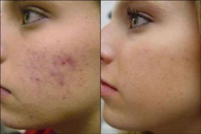 Acne nunca mais!