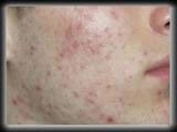 Acne nunca mais!