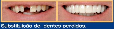 Snap On Smile (em Santos)