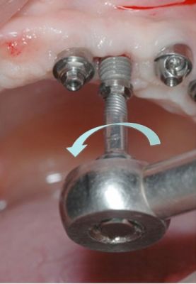 Saca Implante atraumático ou Removedor de Implante atraumático