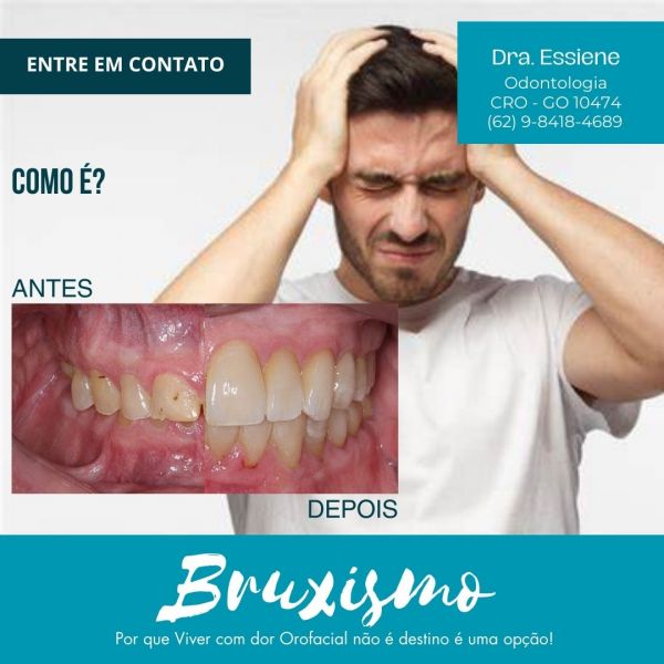BRUXISMO EM GOIÂNIA TRATAMENTO Dra.Essiene